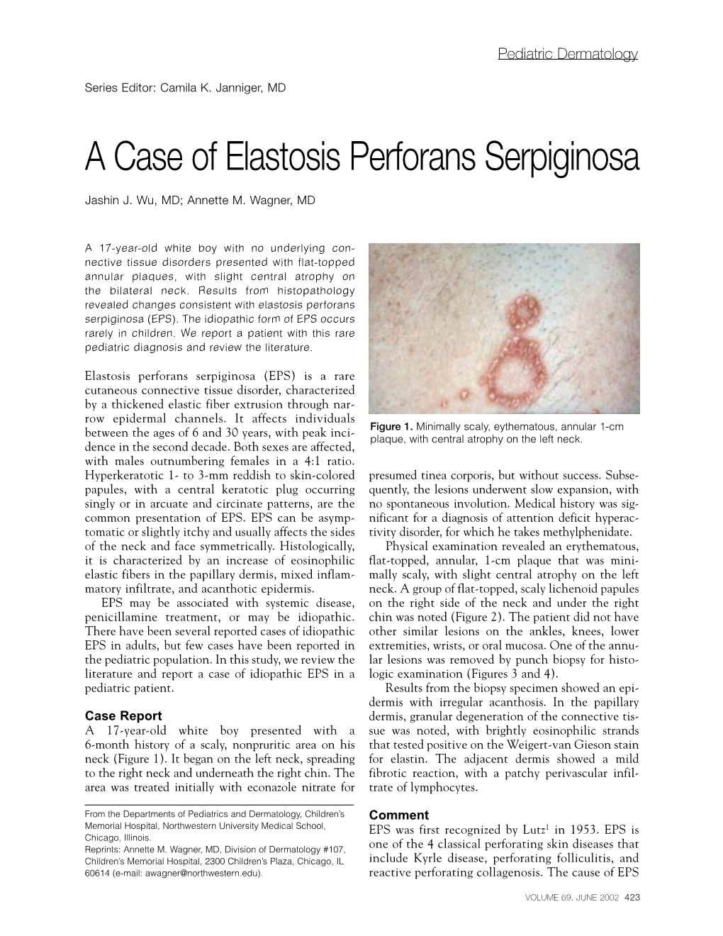 A Case of Elastosis Perforans Serpiginosa