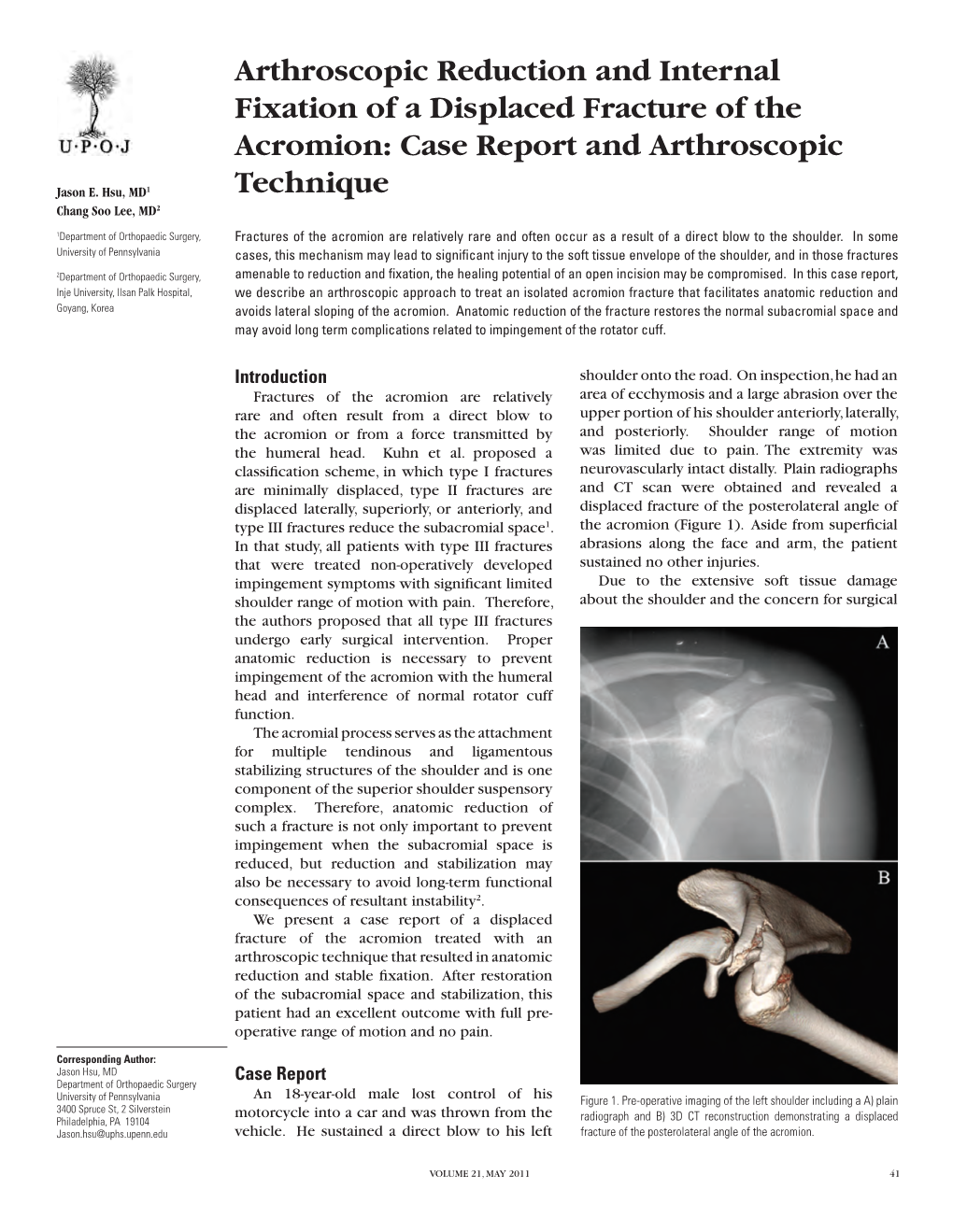 Arthroscopic Reduction and Internal Fixation of a Displaced Fracture of the Acromion: Case Report and Arthroscopic