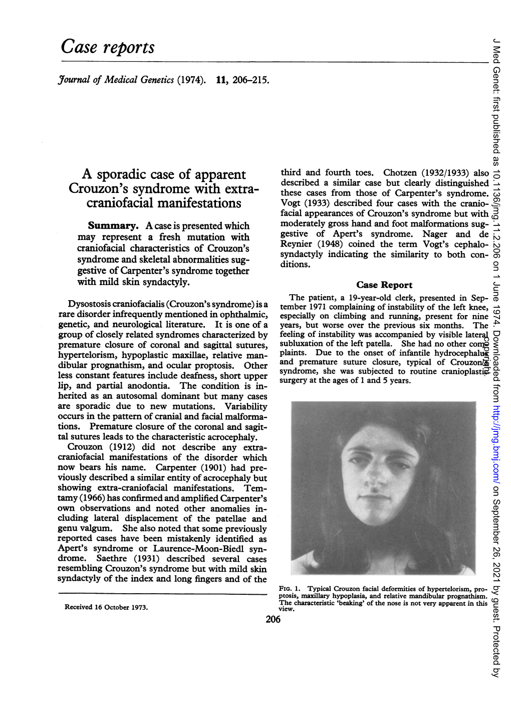 Case Reports Crouzon's Syndrome with Extra- Craniofacial Matifestations