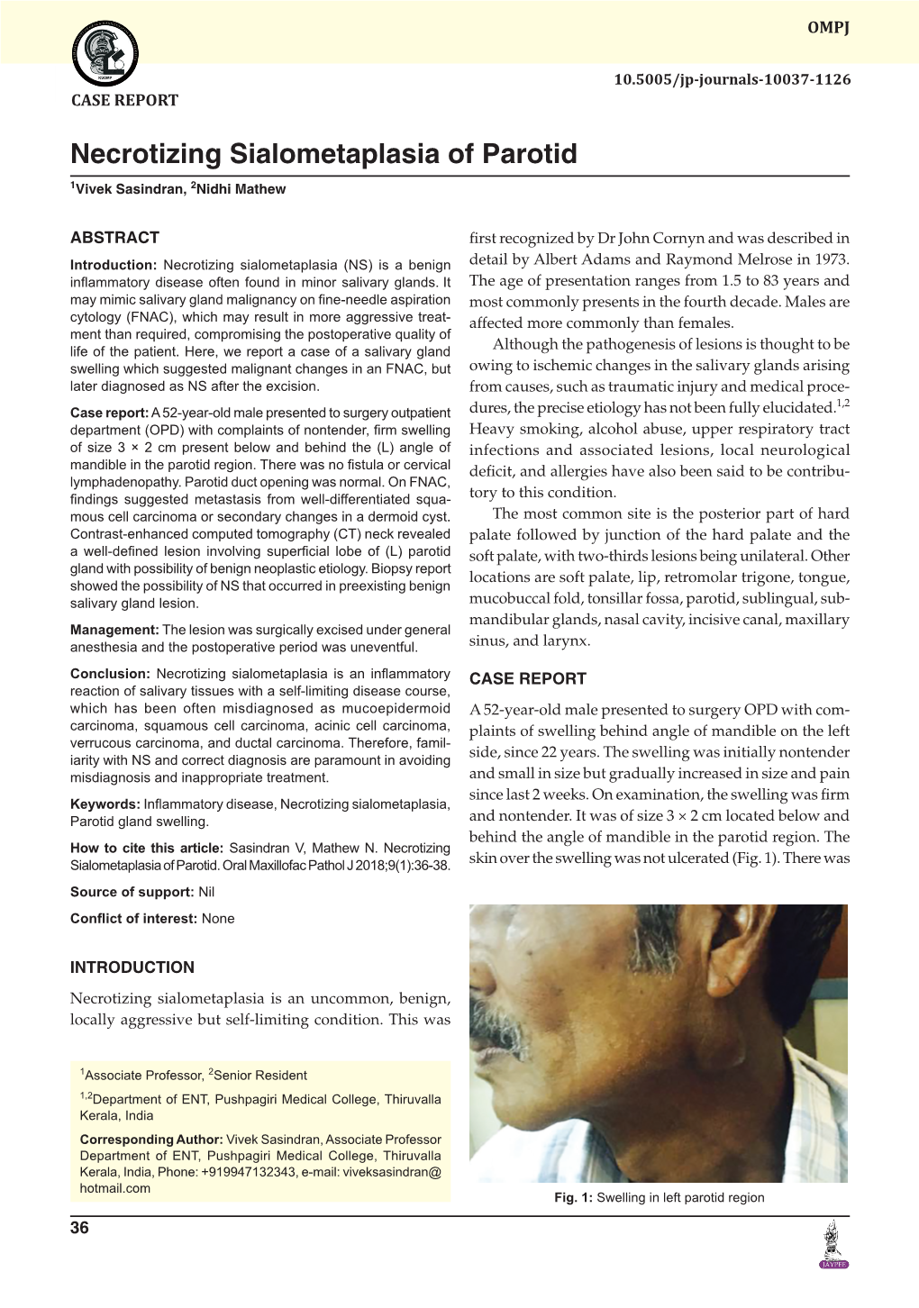 Necrotizing Sialometaplasia of Parotid 1Vivek Sasindran, 2Nidhi Mathew