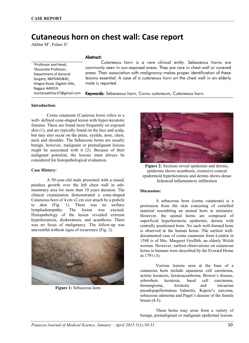 Cutaneous Horn on Chest Wall: Case Report Akhtar M1, Fulare S2