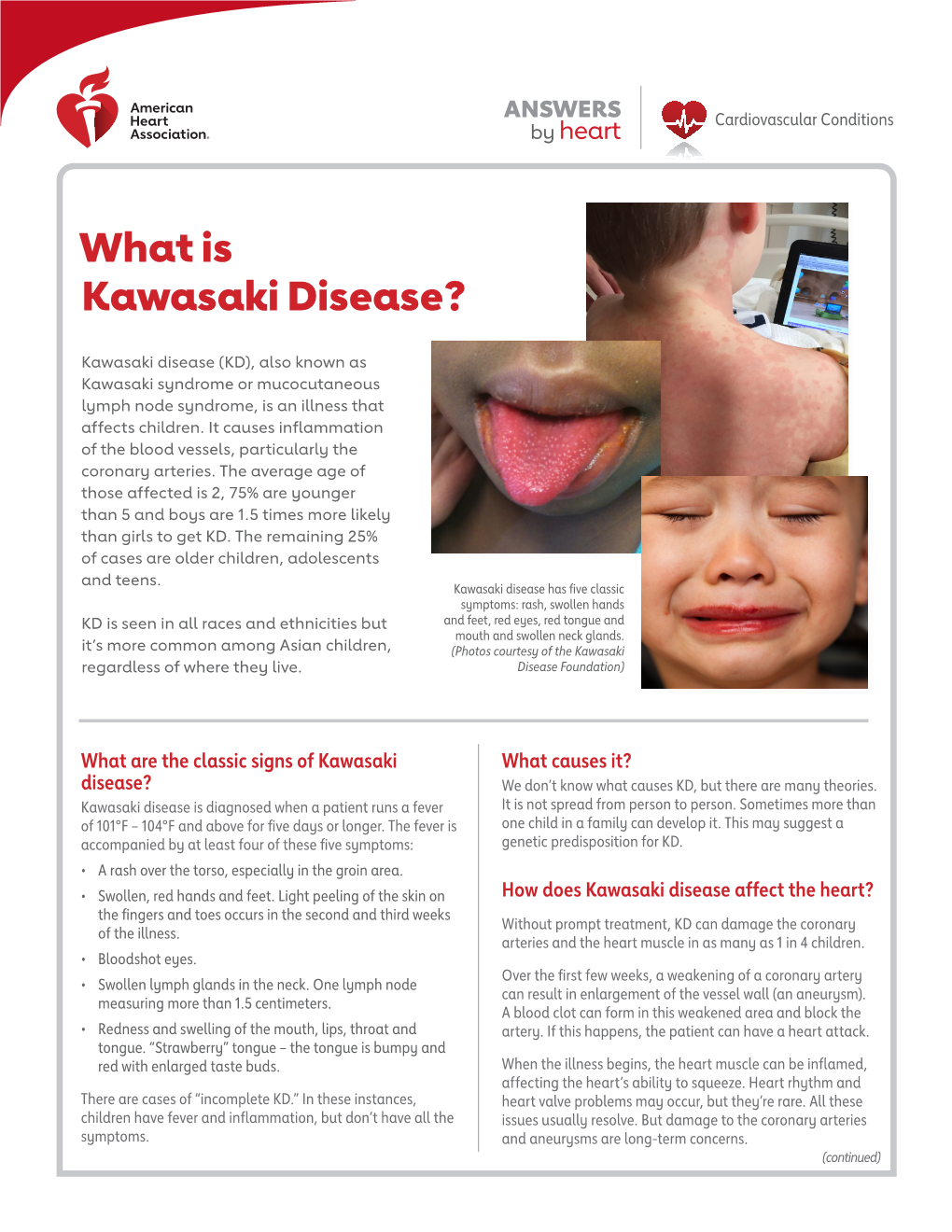 What Is Kawasaki Disease?