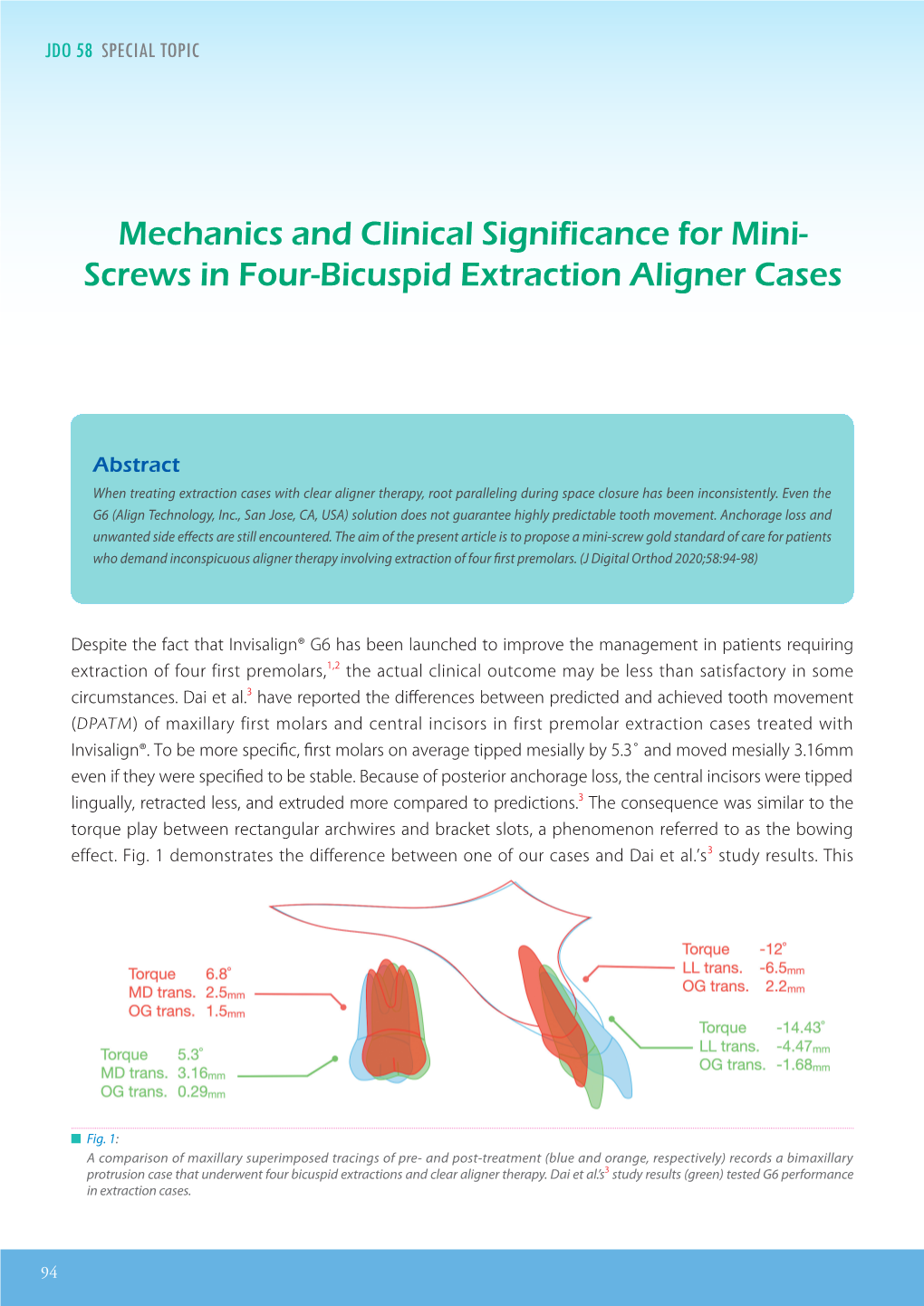 Mechanics and Clinical Significance for Mini- Screws in Four-Bicuspid Extraction Aligner Cases