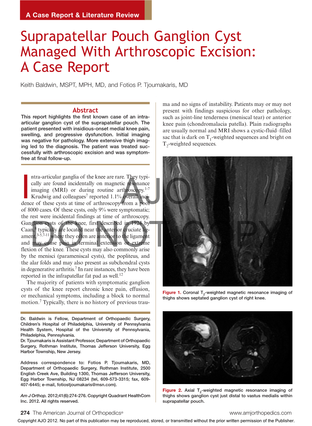 Suprapatellar Pouch Ganglion Cyst Managed with Arthroscopic Excision: a Case Report