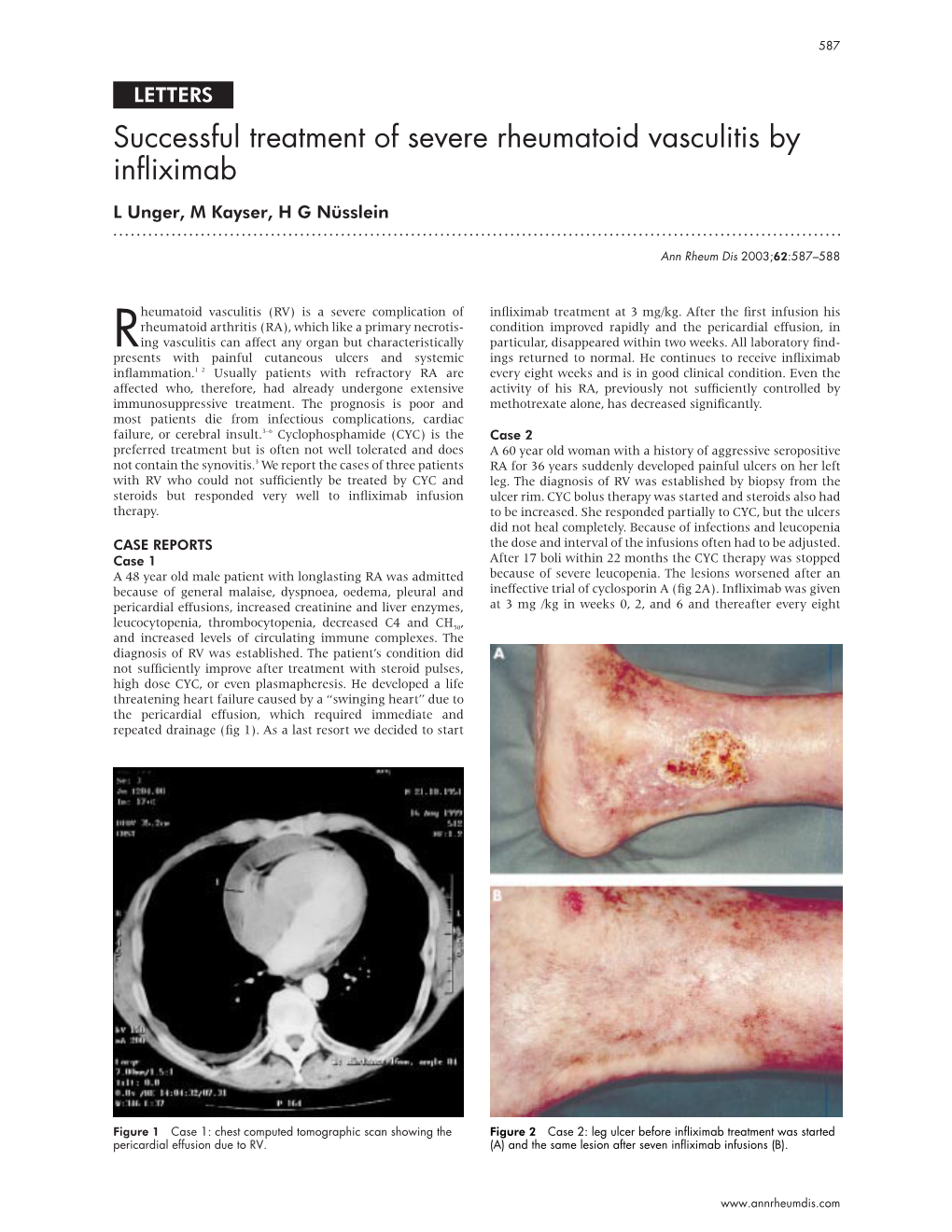 Successful Treatment of Severe Rheumatoid Vasculitis by Infliximab L Unger, M Kayser, H G Nüsslein