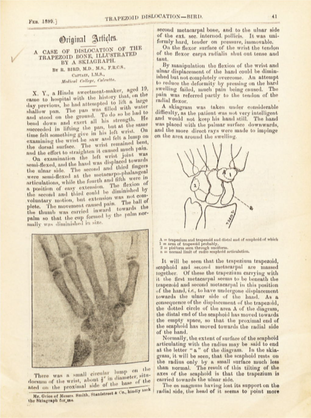 A Case of Dislocation of the Trapezoid Bone,Illustrated by a Skiagraph