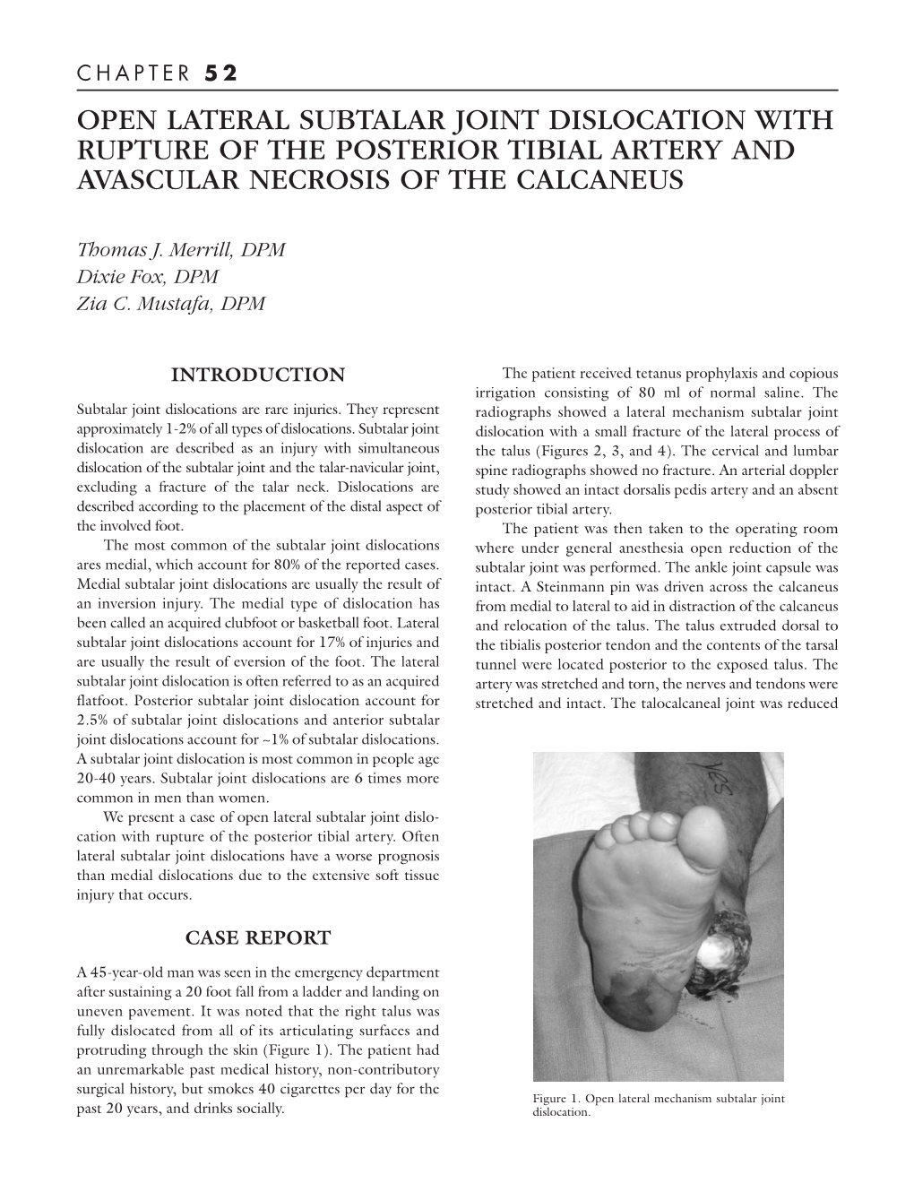 Open Lateral Subtalar Joint Dislocation with Rupture of the Posterior Tibial Artery and Avascular Necrosis of the Calcaneus