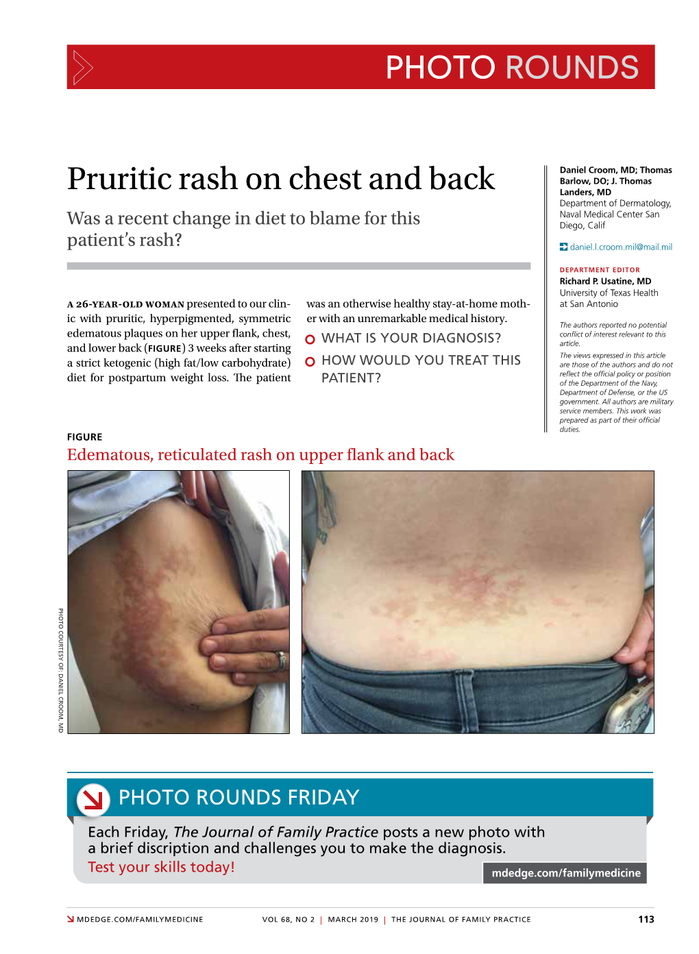 Pruritic Rash on Chest and Back Landers, MD Department of Dermatology, Naval Medical Center San Was a Recent Change in Diet to Blame for This Diego, Calif