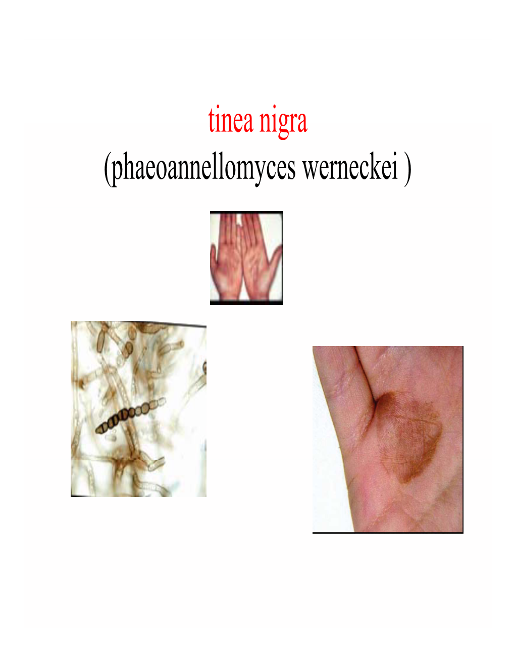 Tinea Nigra (Phaeoannellomyces Werneckei ) Tinea Nigra