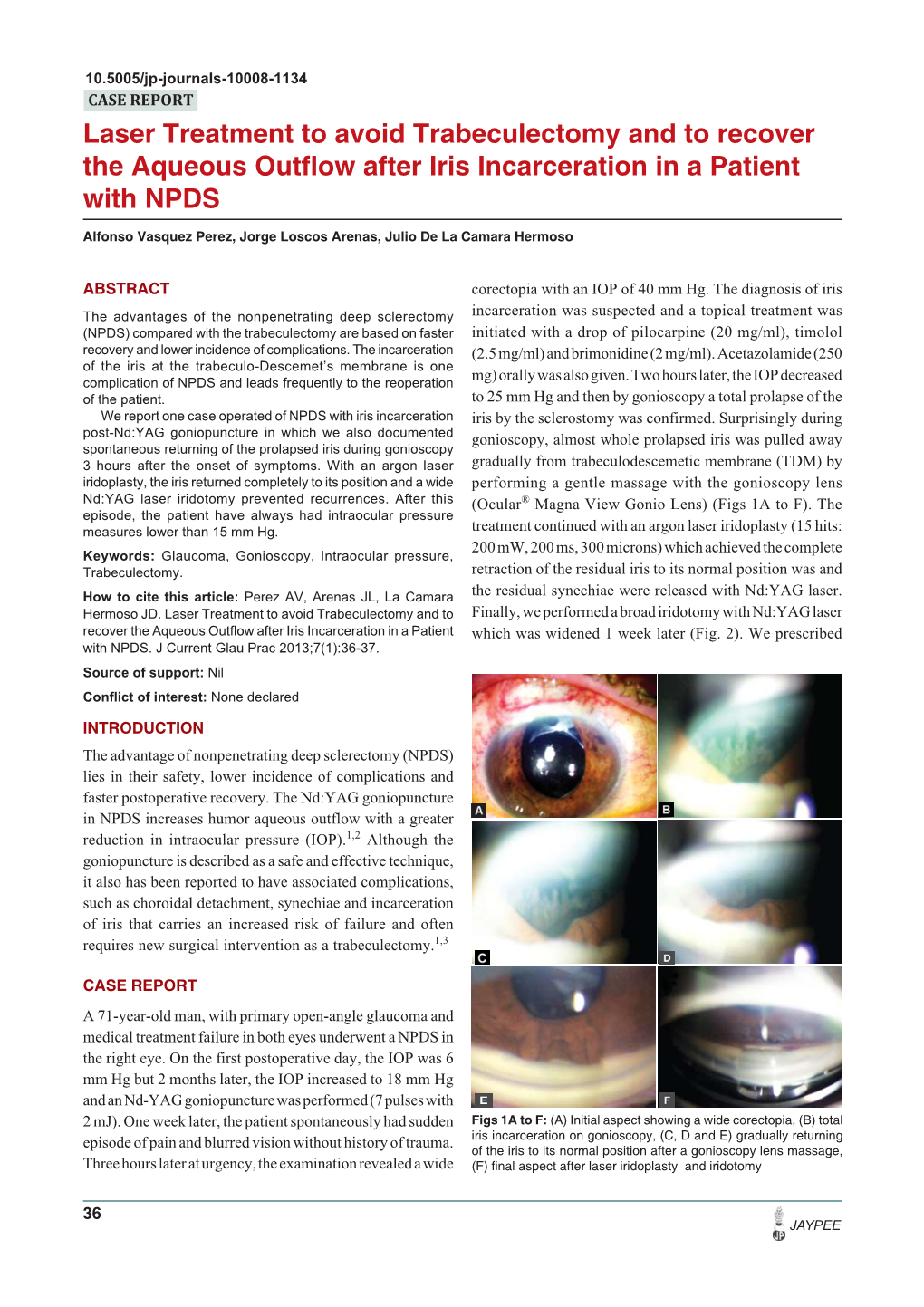 Laser Treatment to Avoid Trabeculectomy.Pdf
