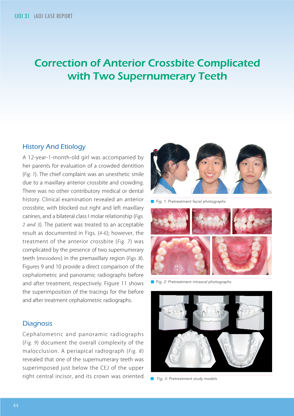 Correction of Anterior Crossbite Complicated with Two Supernumerary Teeth IJOI 31