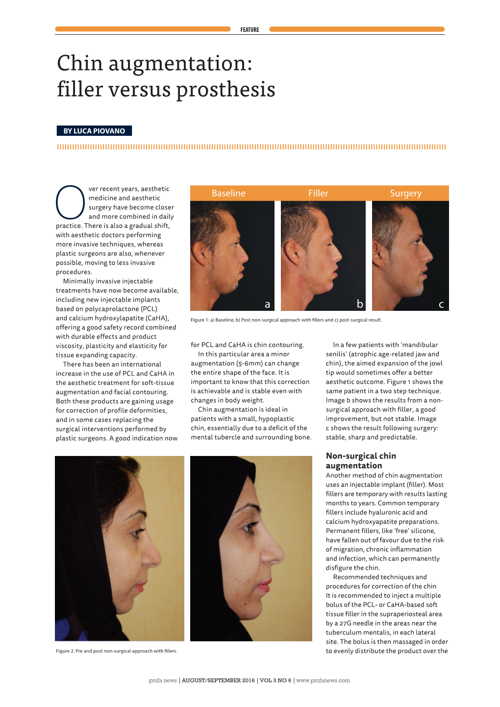 Chin Augmentation: Filler Versus Prosthesis