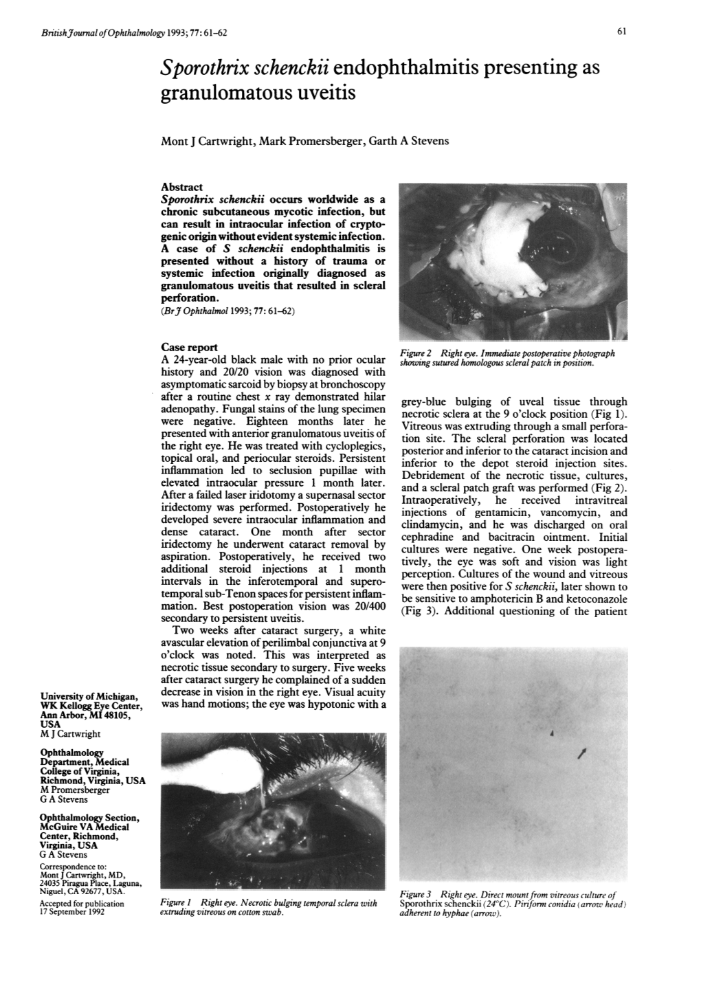 Sporothrix Schenckii Endophthalmitis Presenting As Granulomatous Uveitis