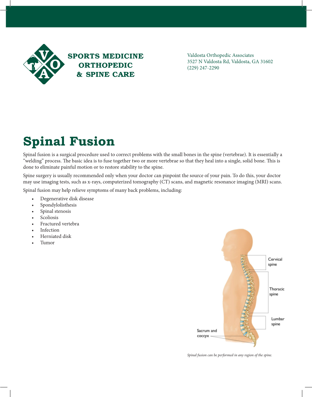 Spinal Fusion Spinal Fusion Is a Surgical Procedure Used to Correct Problems with the Small Bones in the Spine (Vertebrae)