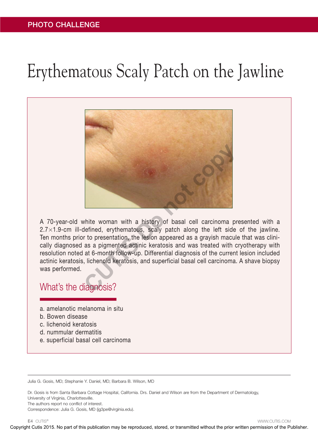 Erythematous Scaly Patch on the Jawline