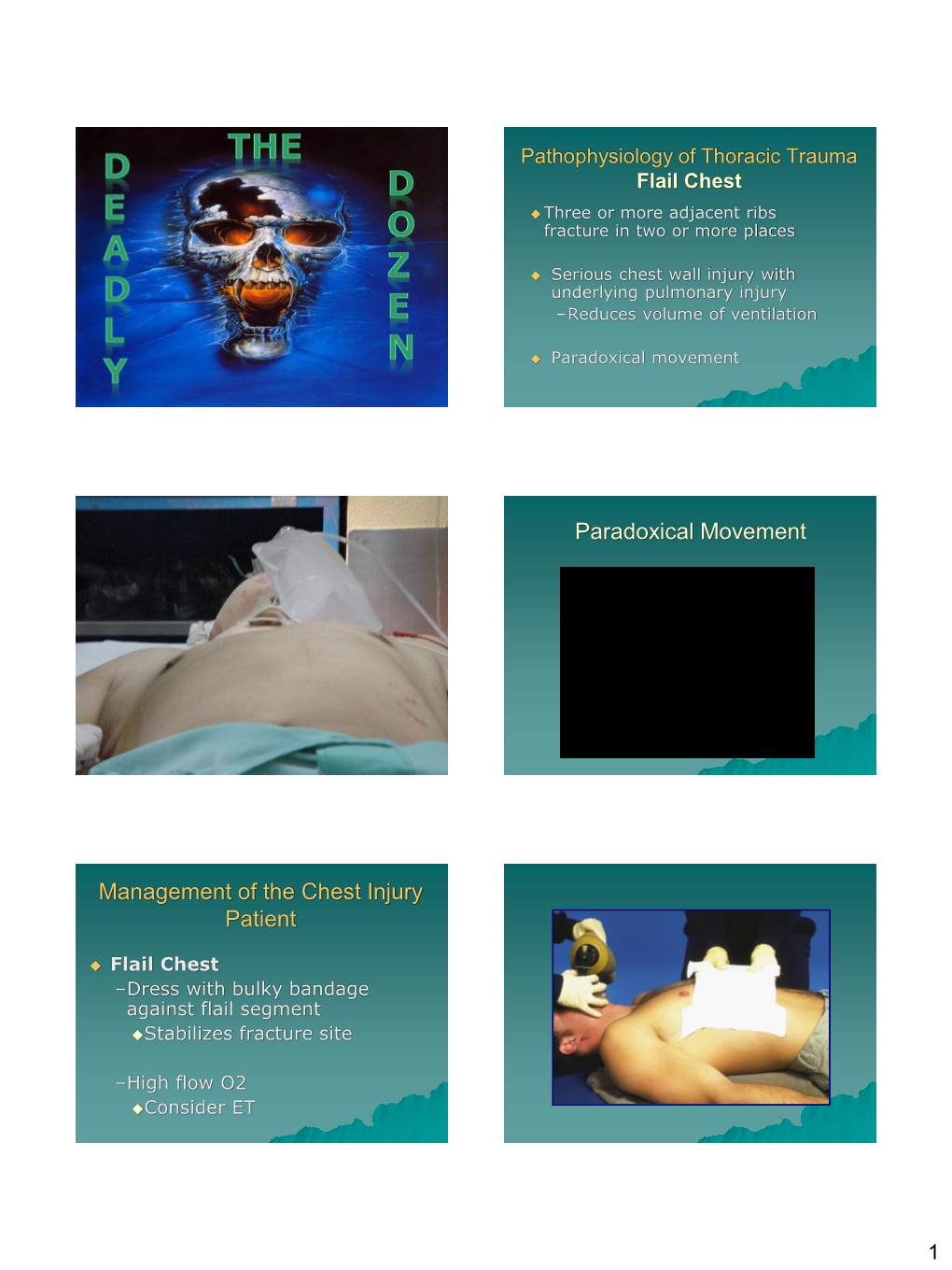 Paradoxical Movement Management of the Chest Injury Patient