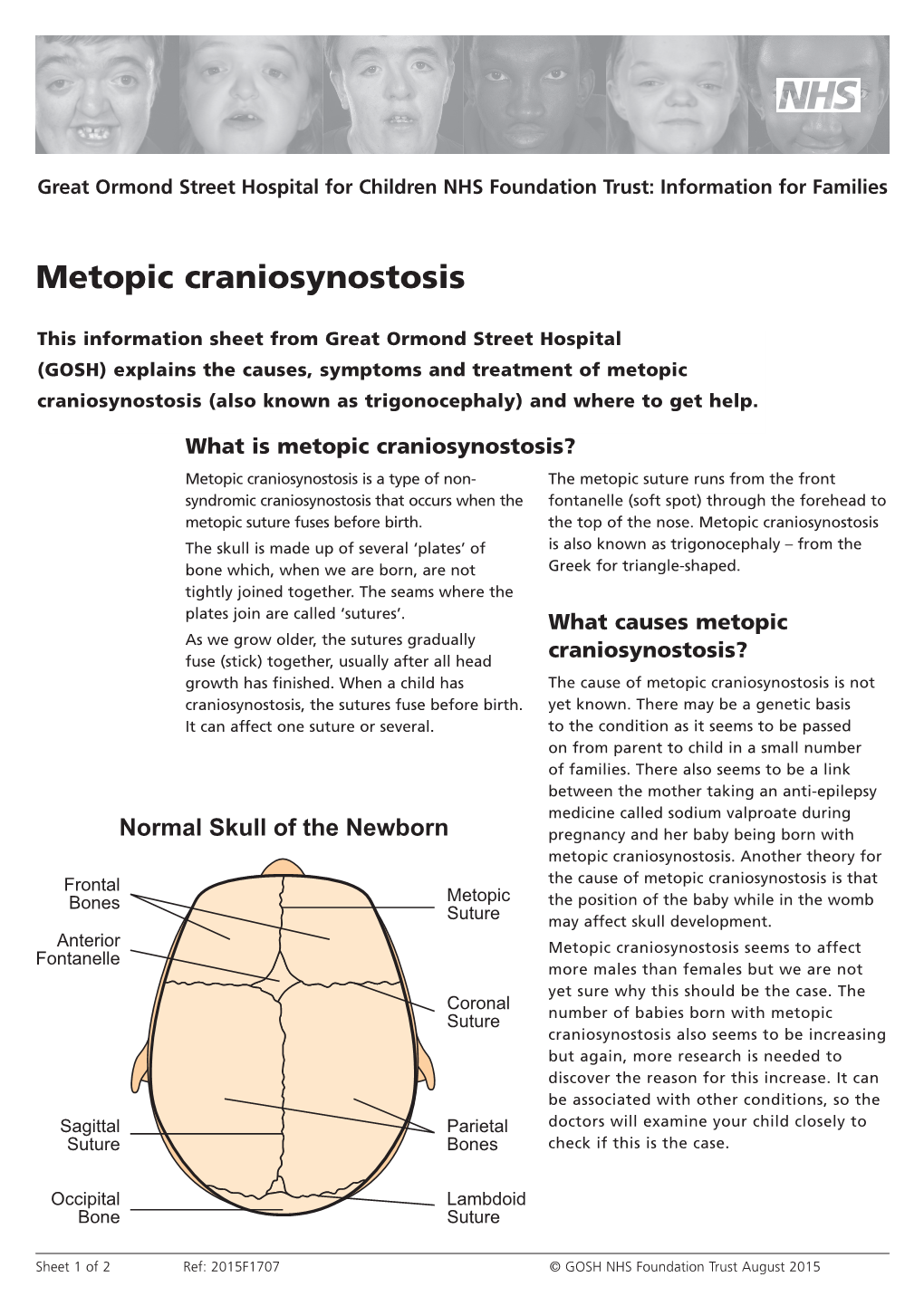 Metopic Craniosynostosis