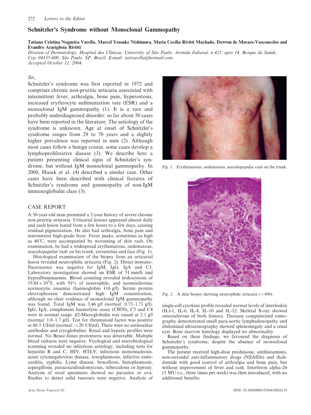 Schnitzler's Syndrome Without Monoclonal Gammopathy