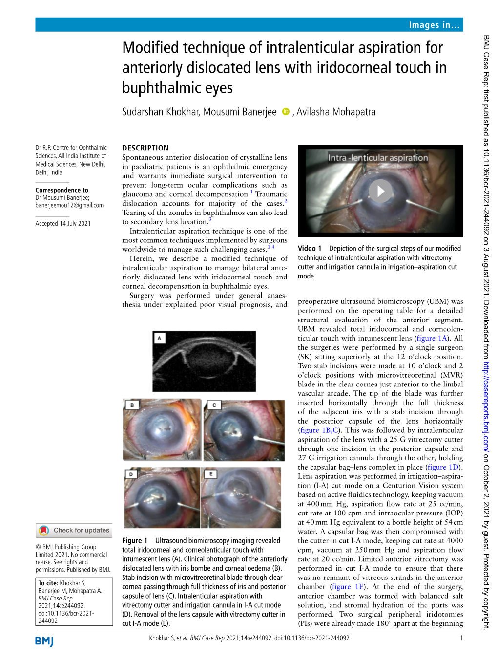 Modified Technique of Intralenticular Aspiration for Anteriorly Dislocated Lens with Iridocorneal Touch in Buphthalmic Eyes