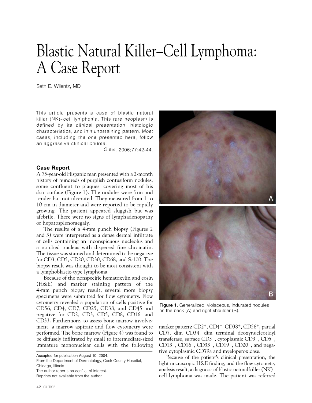 Blastic Natural Killer–Cell Lymphoma: a Case Report