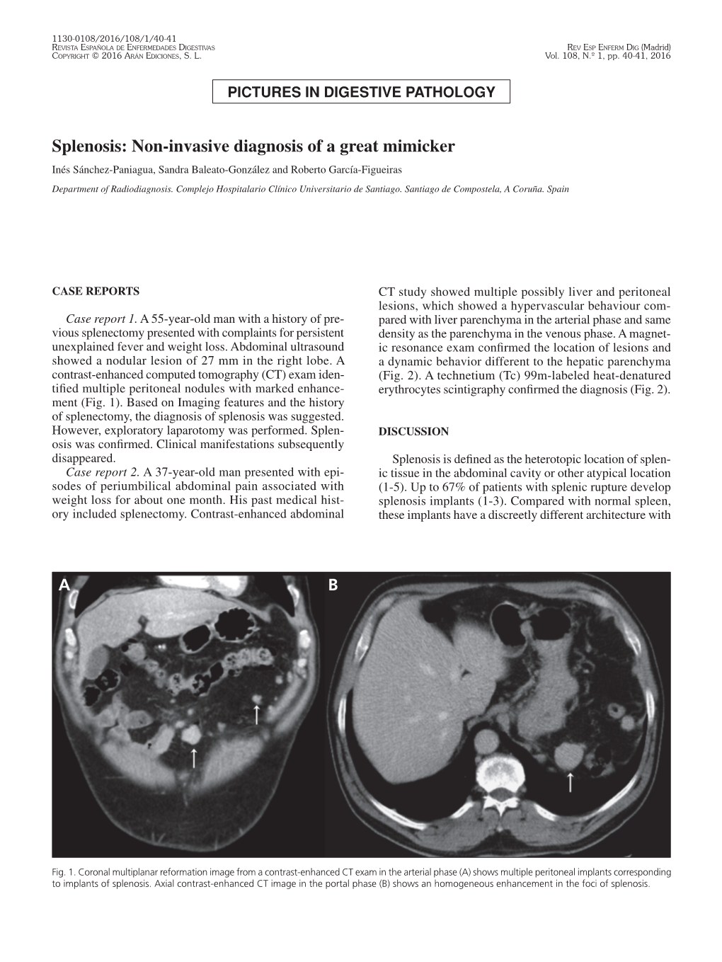 Splenosis: Non-Invasive Diagnosis of a Great Mimicker Inés Sánchez-Paniagua, Sandra Baleato-González and Roberto García-Figueiras Department of Radiodiagnosis