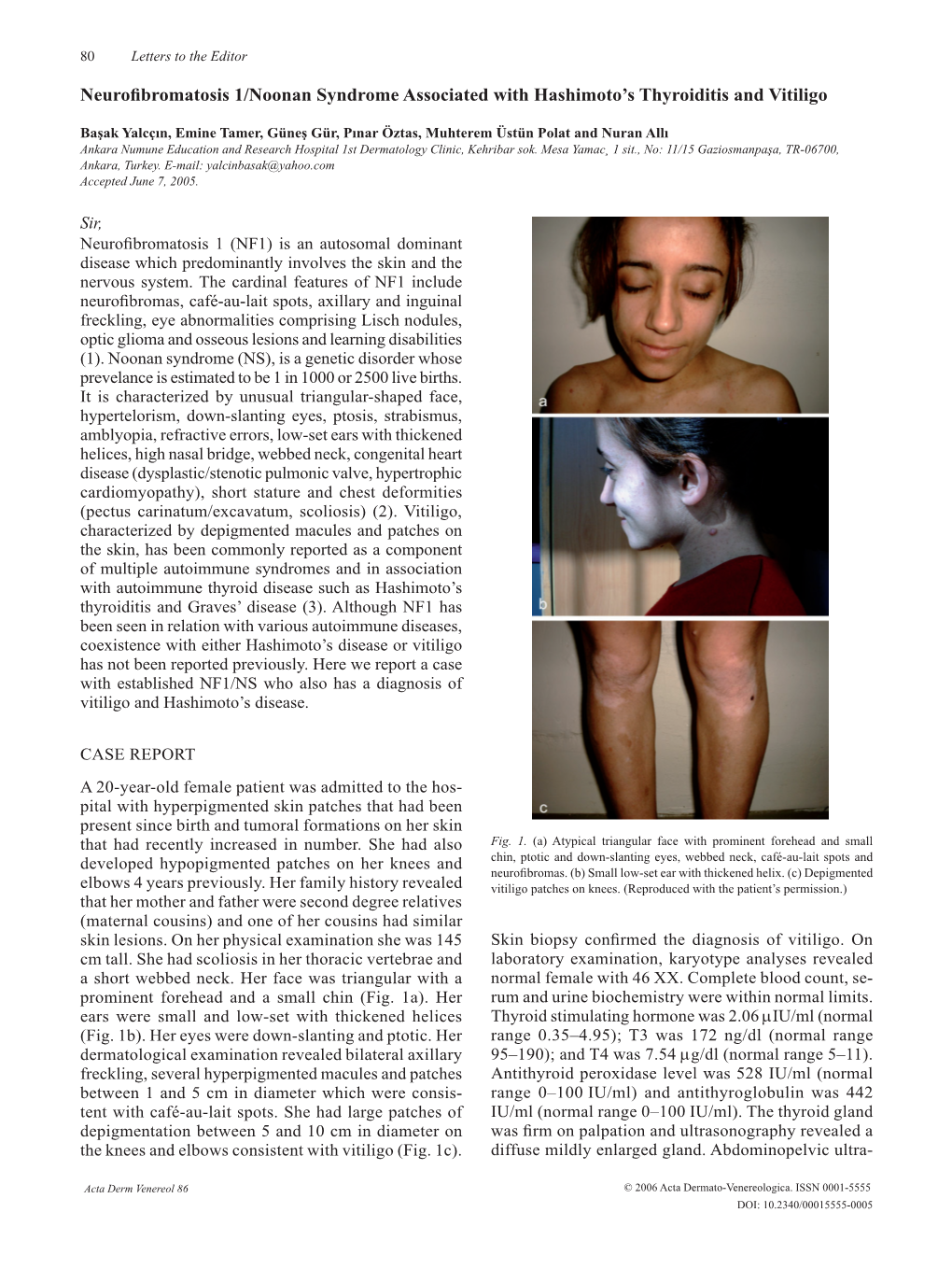 Neurofibromatosis 1/Noonan Syndrome Associated with Hashimoto's Thyroiditis and Vitiligo