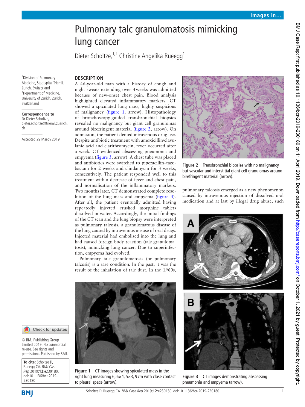 Pulmonary Talc Granulomatosis Mimicking Lung Cancer Dieter Scholtze,1,2 Christine Angelika Rueegg1