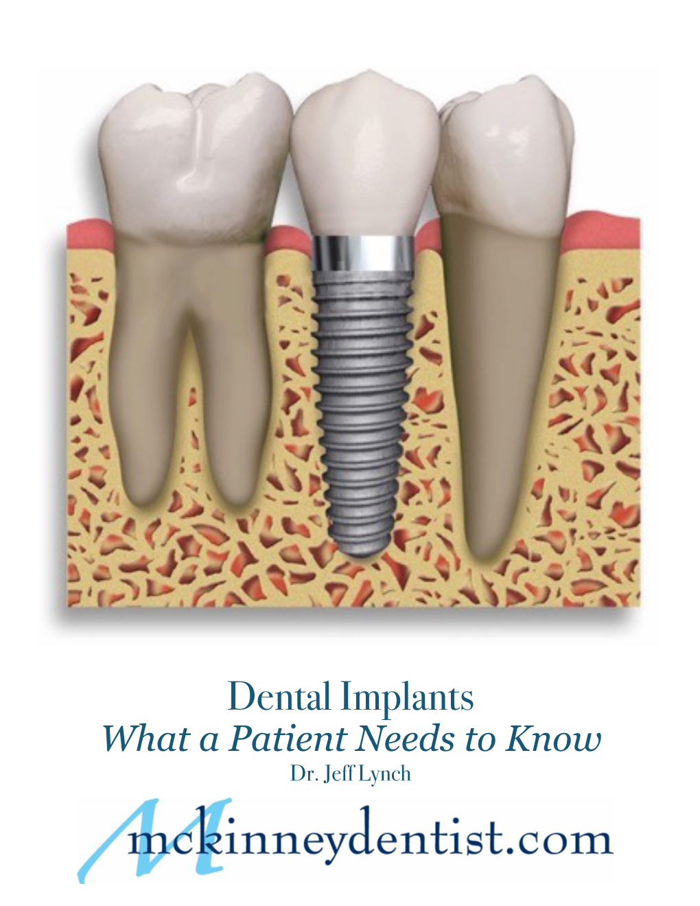 Dental Implants What a Patient Needs to Know Dr