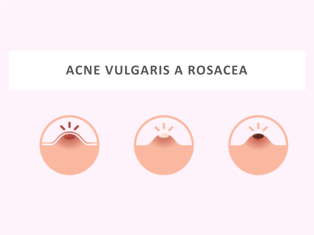 Akné a Rosacea