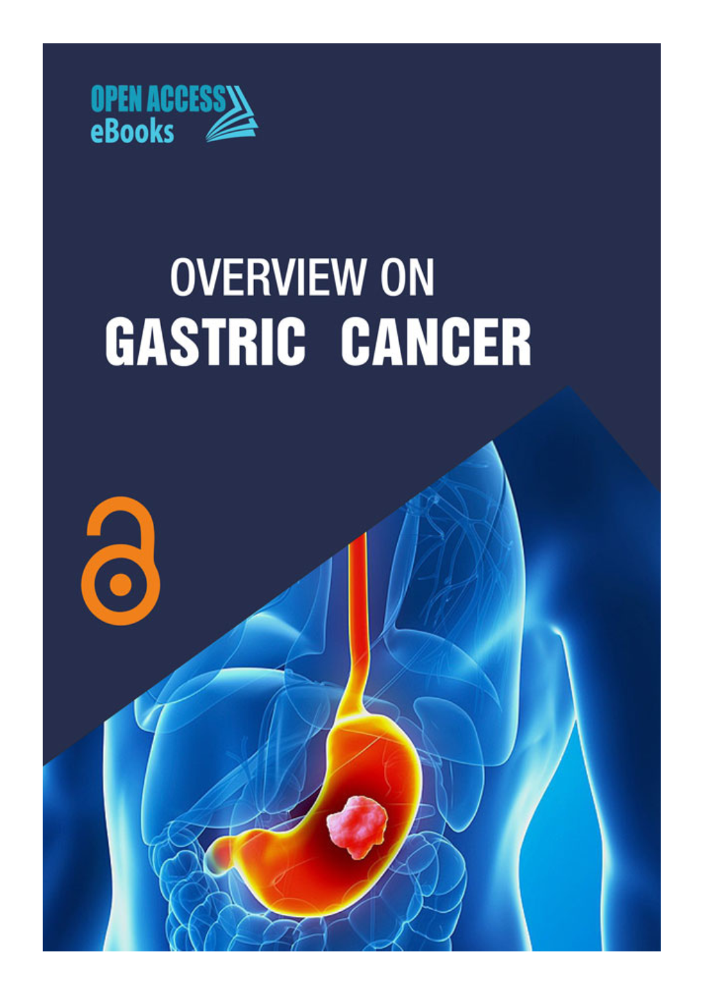 Overview on Gastric Cancer