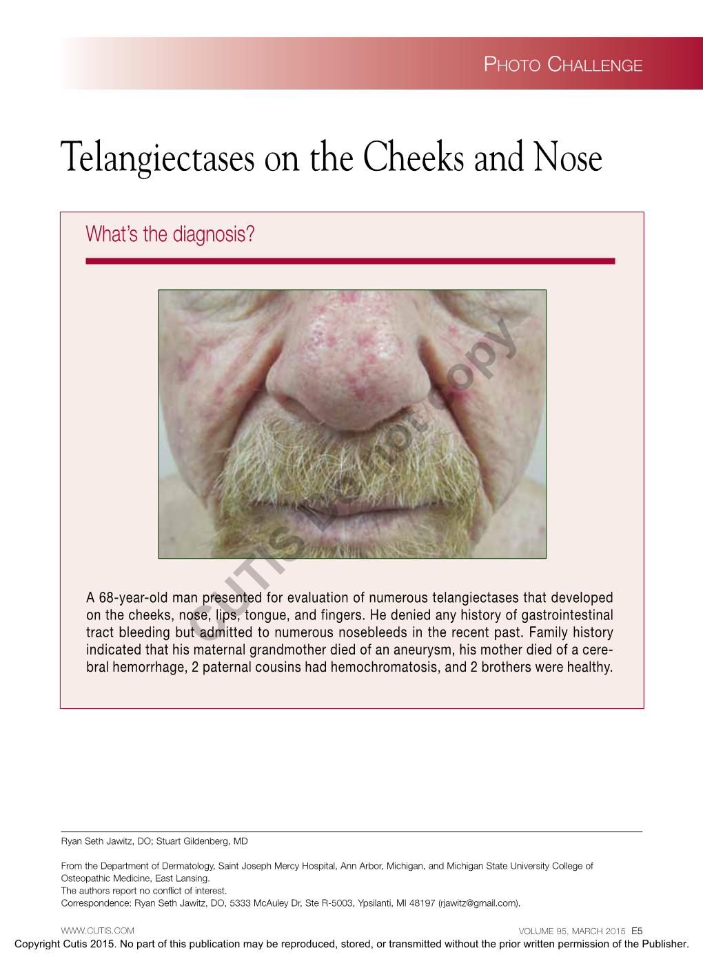 Telangiectases on the Cheeks and Nose