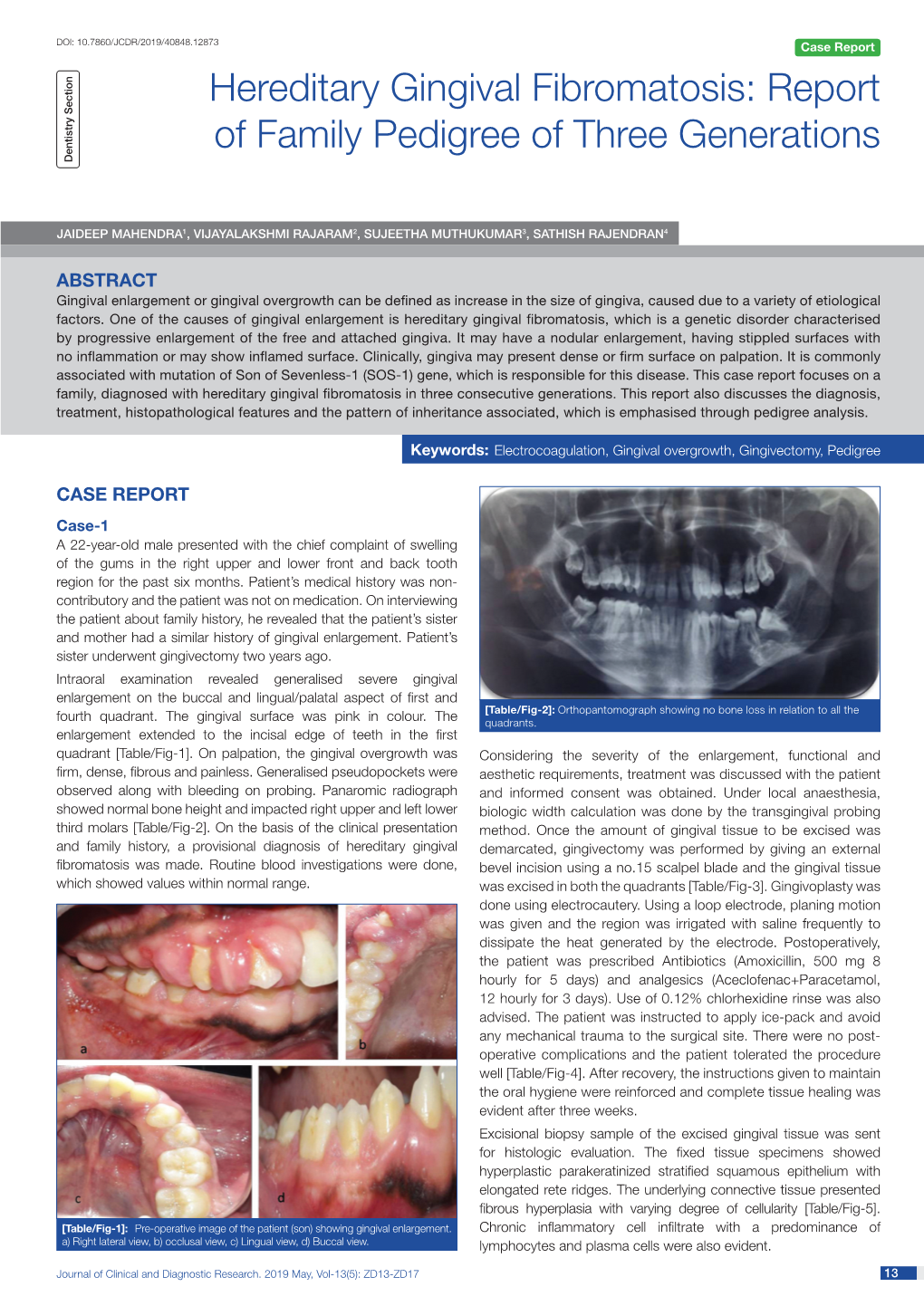 Hereditary Gingival Fibromatosis: Report of Family Pedigree of Three Generations Dentistry Section