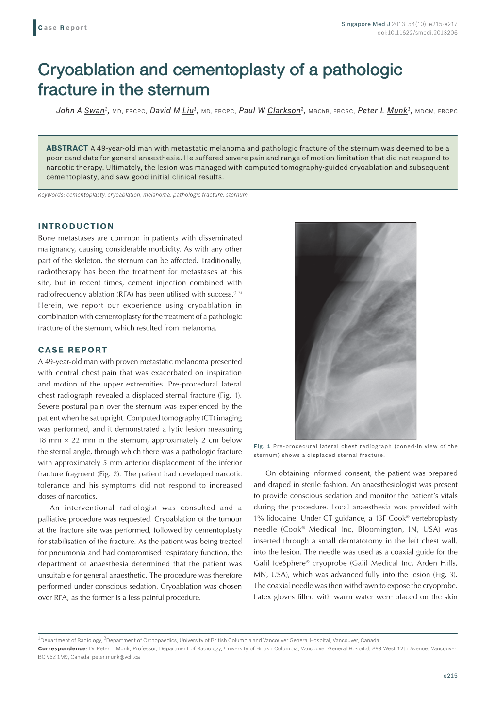 Cryoablation and Cementoplasty of a Pathologic Fracture in the Sternum