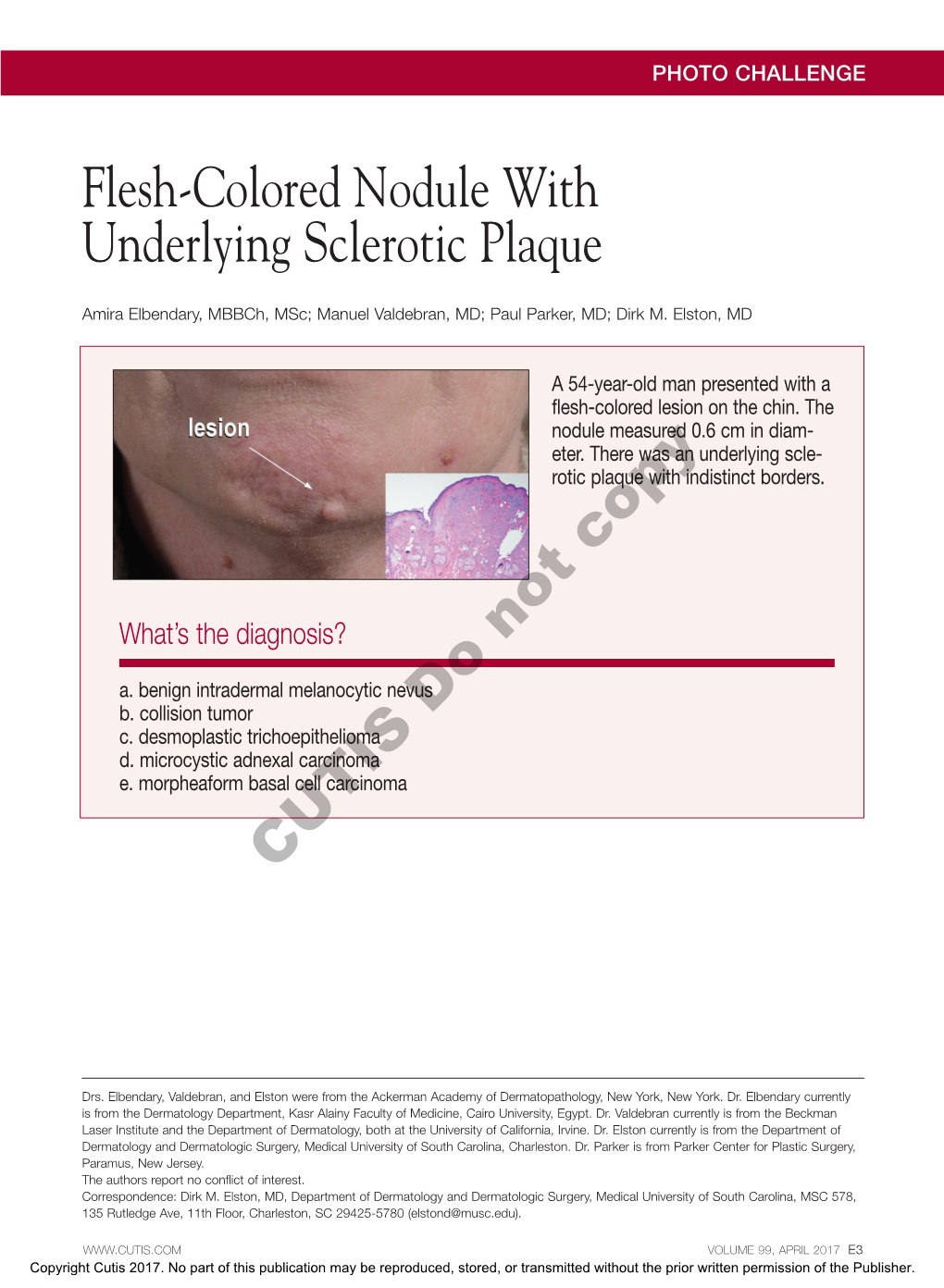 Flesh-Colored Nodule with Underlying Sclerotic Plaque