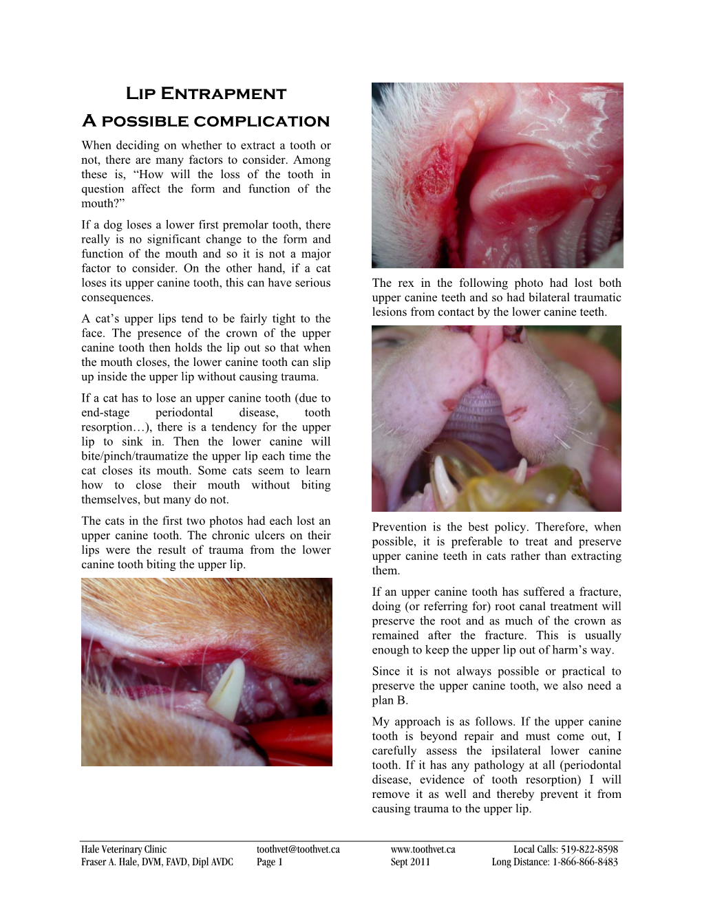 Lip Entrapment a Possible Complication When Deciding on Whether to Extract a Tooth Or Not, There Are Many Factors to Consider