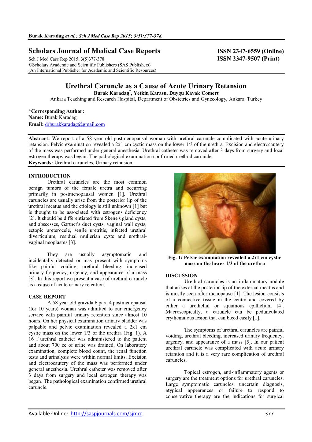 Scholars Journal of Medical Case Reports Urethral Caruncle As a Cause of Acute Urinary Retansion
