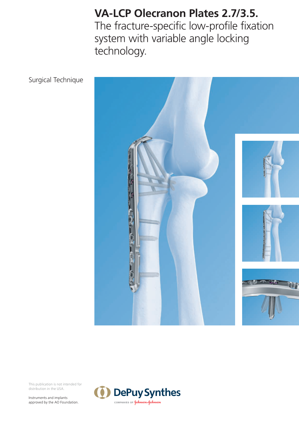 VA-LCP Olecranon Plates 2.7/3.5. the Fracture-Specific Low-Profile Fixation System with Variable Angle Locking Technology