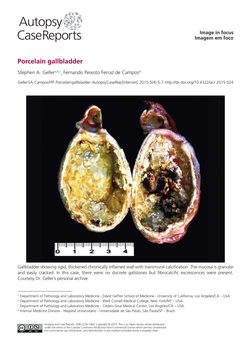 Porcelain Gallbladder