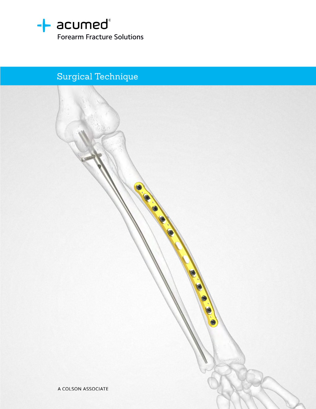 Forearm Fracture Solutions Surgical Technique (ELB10-02-G)