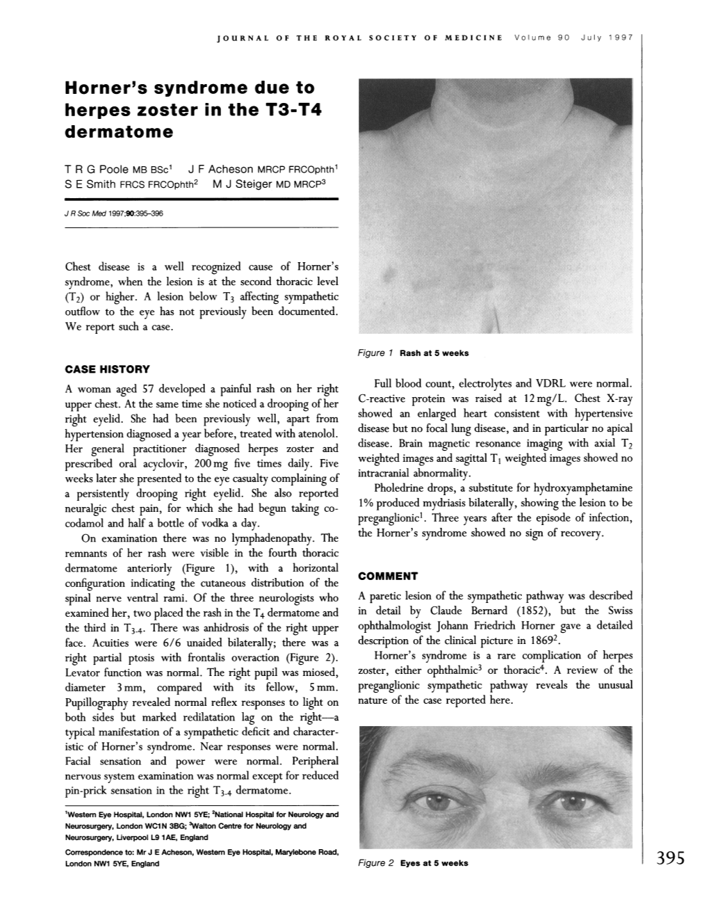 Horner's Syndrome Due to Herpes Zoster in the T3-T4 Dermatome