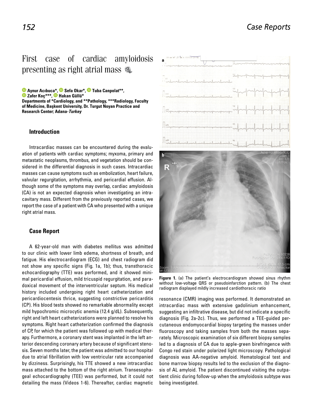 First Case of Cardiac Amyloidosis Presenting As Right Atrial Mass