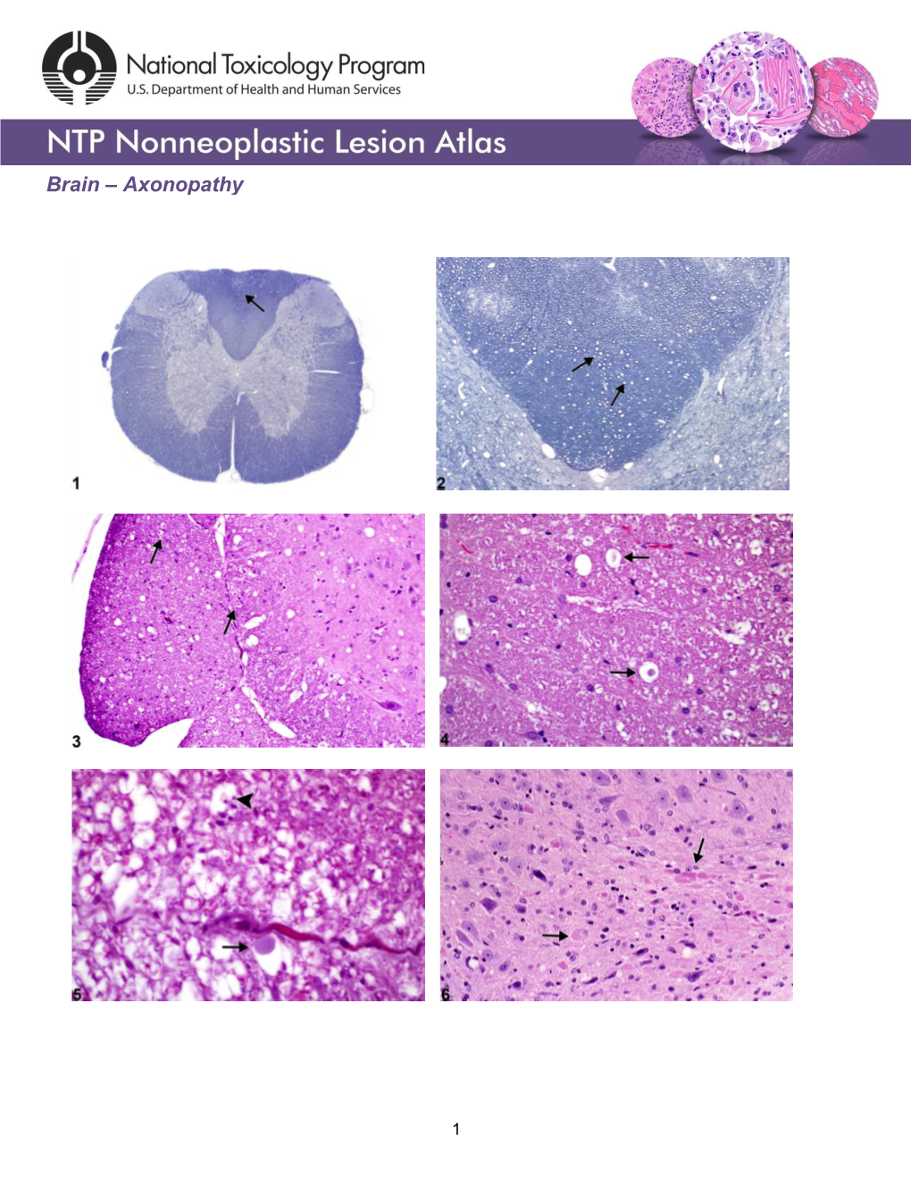 Brain – Axonopathy