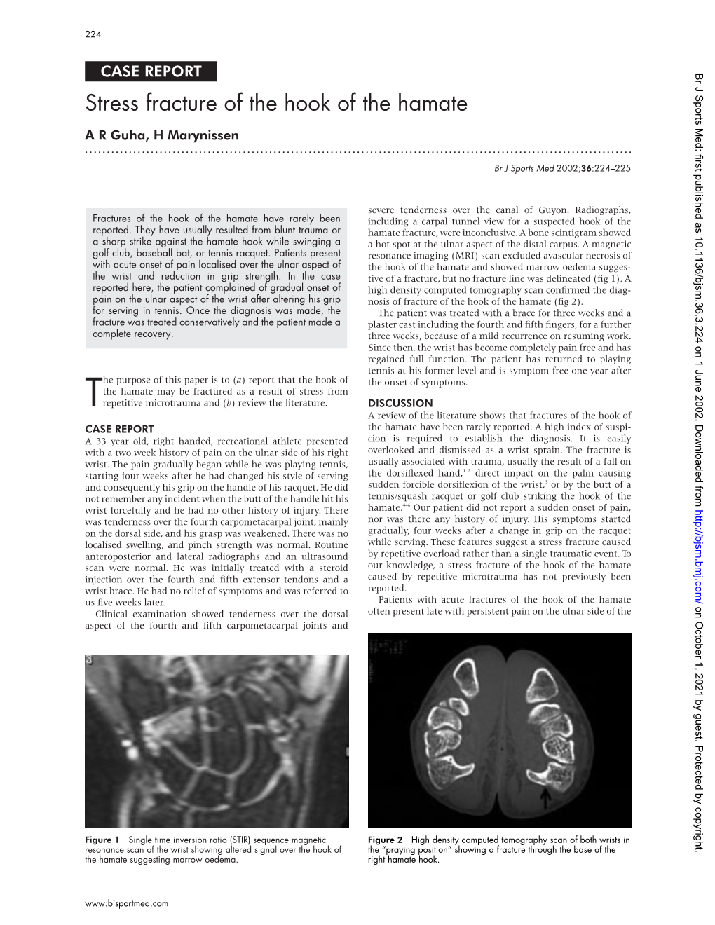 Stress Fracture of the Hook of the Hamate a R Guha, H Marynissen