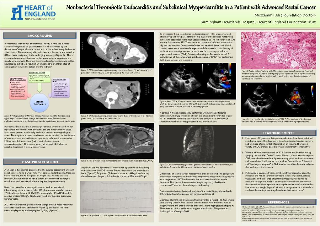 Nonbacterial Thrombotic Endocarditis and Subclinical Myopericarditis in A