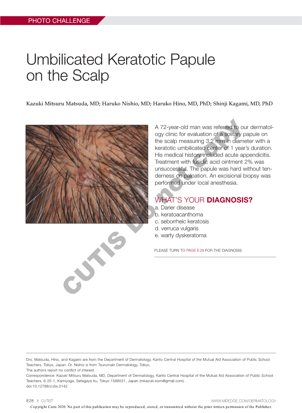 Umbilicated Keratotic Papule on the Scalp
