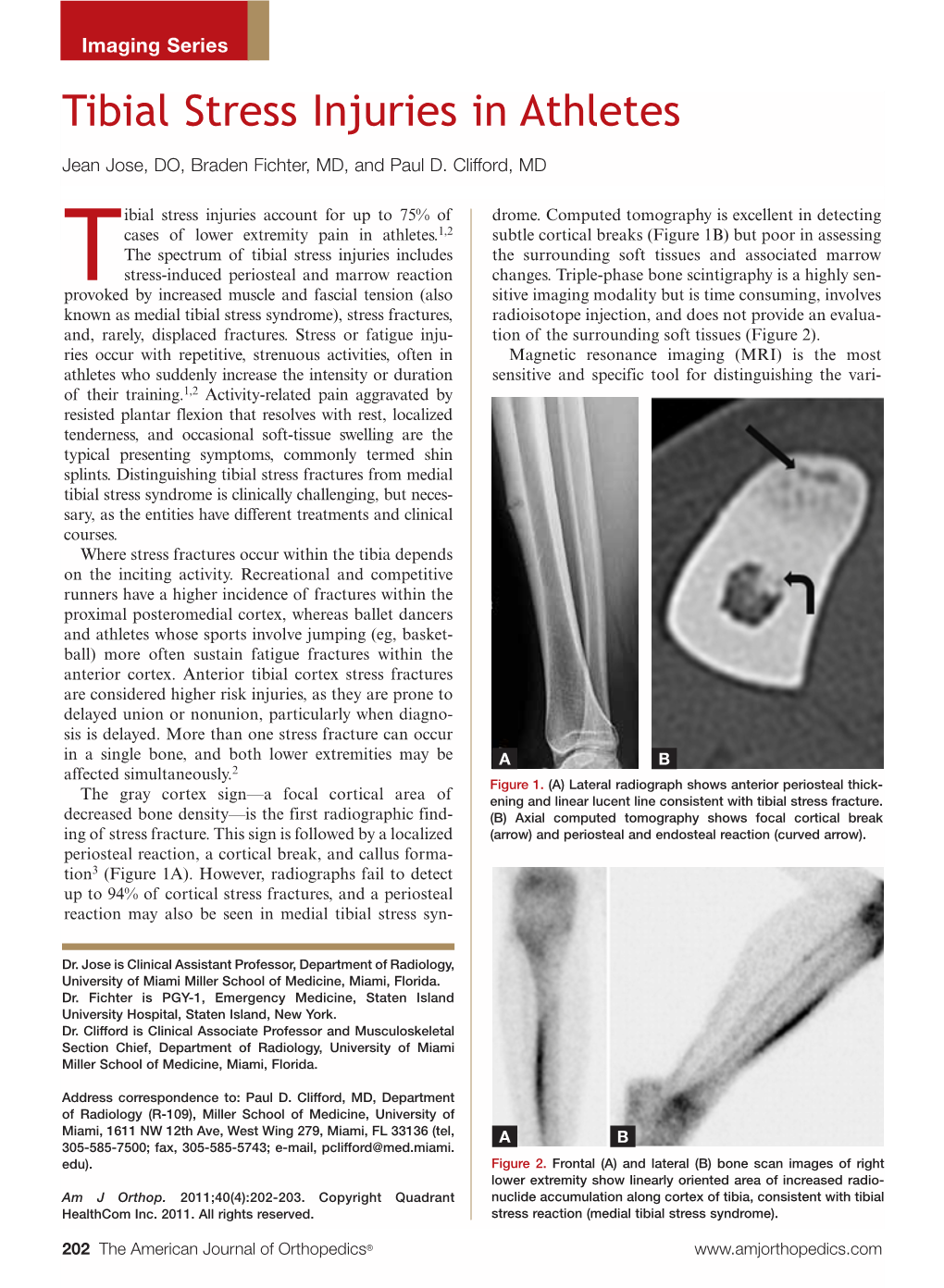 Tibial Stress Injuries in Athletes