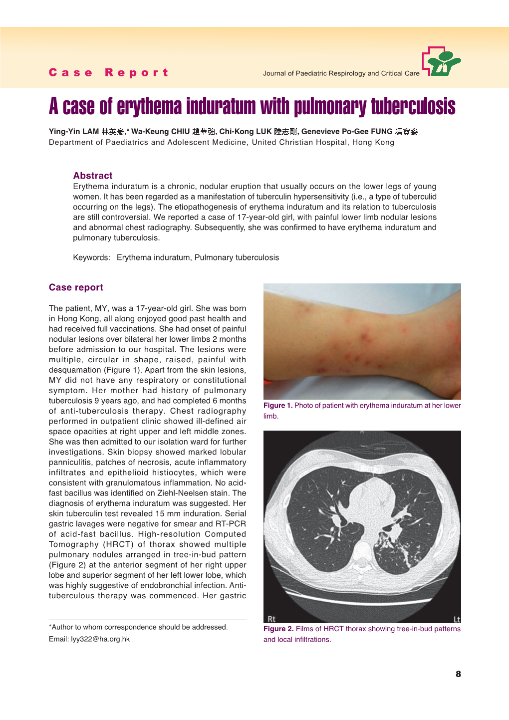 A Case of Erythema Induratum with Pulmonary Tuberculosis