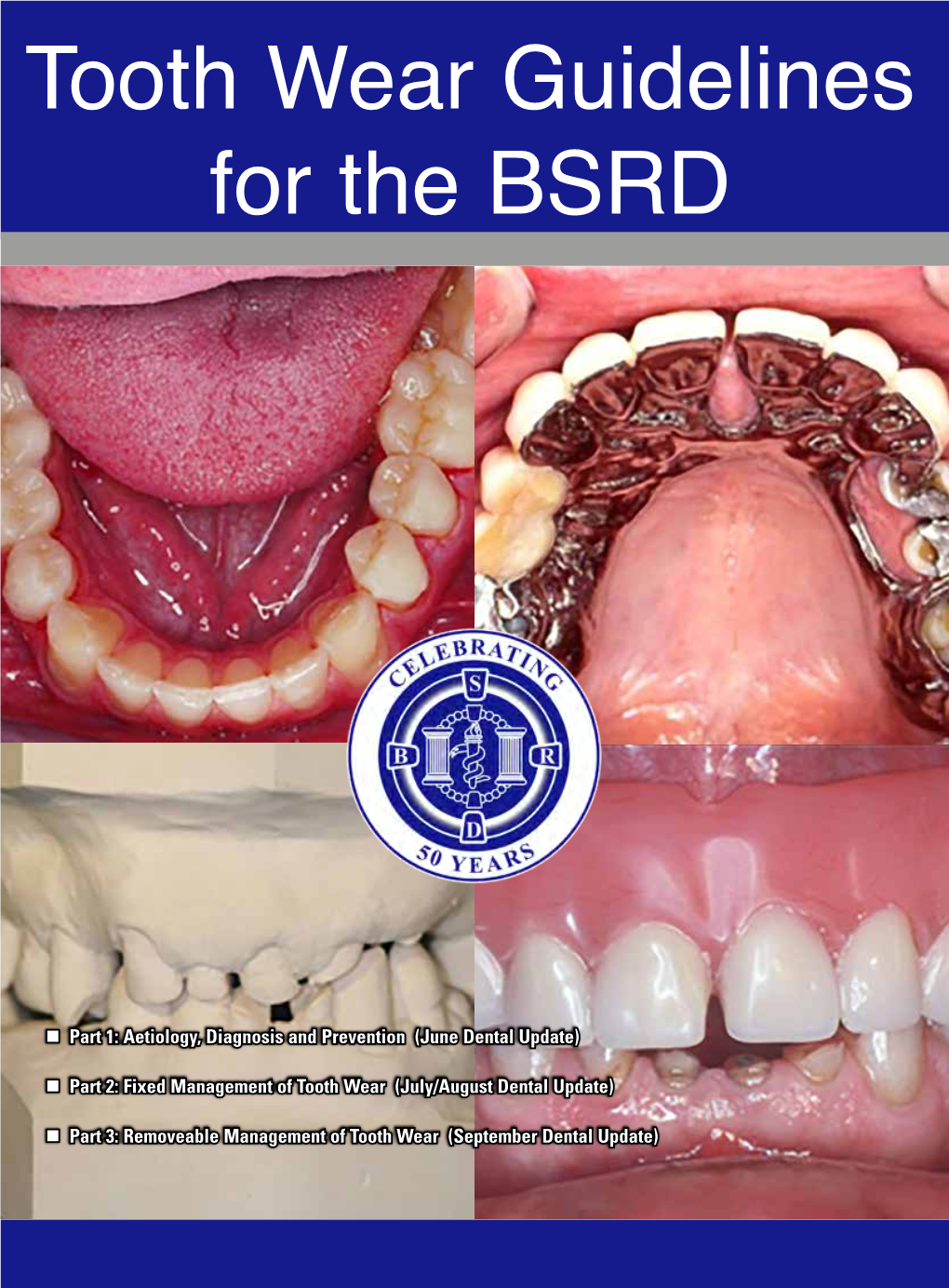 Tooth Wear Guidelines for the BSRD