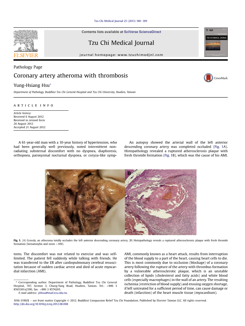 Coronary Artery Atheroma with Thrombosis