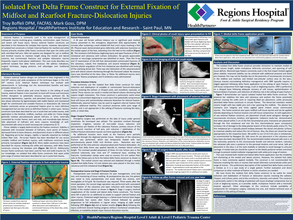 Isolated Foot Delta Frame Construct for External Fixation of Midfoot And